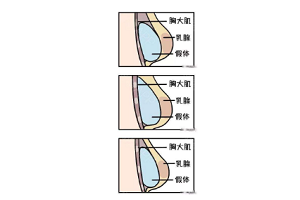 假体隆胸术后触感柔软吗