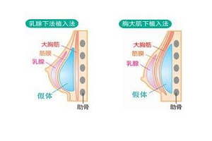 假体隆胸的术后效果怎么样