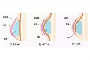 自体脂肪隆胸整形多少钱