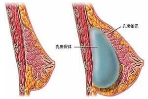 假体隆胸要多少钱呢