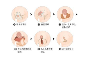 巨乳缩小术的优点有哪些