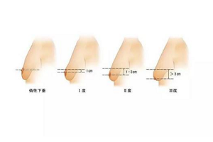 乳房下垂矫正的方法