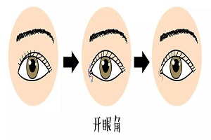 开眼角手术的三大优势