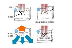 激光祛雀斑需要多注意这几点