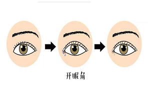 开眼角手术 扩大您的眼部视线