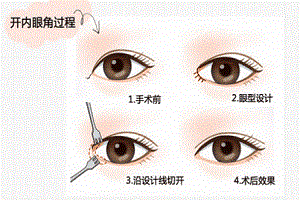 开内眼角术前应该注意些什么