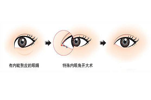 开内眼角矫正手术的效果