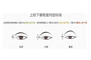 上海眼睑下垂矫正的效果