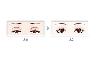 上海眼睑下垂矫正的效果