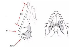 假体隆鼻手术的过程