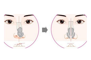 歪鼻矫正手术的术后效果好不好