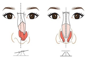 鼻翼整形术前注意事项