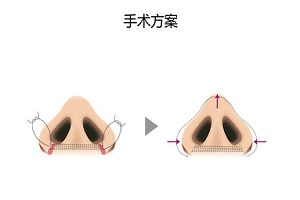 鼻翼缩小术会有副作用吗