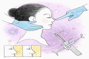 隆鼻失败了 要取出材料吗