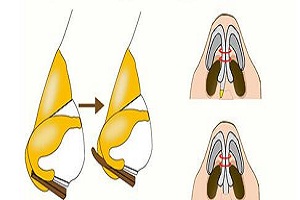 哪些是鼻小柱延长术的特点