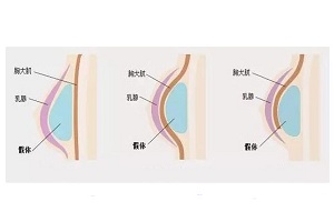 假体隆胸术后恢复时间多久