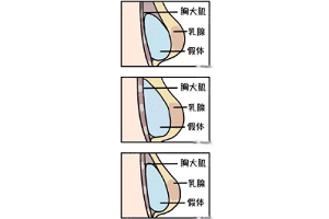 假体隆胸优点有什么