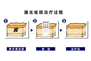 激光祛雀斑的效果怎么样