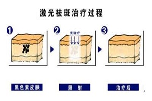 脸上有咖啡斑怎么办