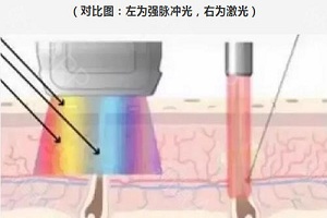 激光是怎样治疗咖啡斑的呢