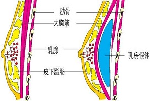 假体隆胸的大小有没有标准呢