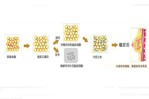 自体脂肪隆胸手术的优缺点