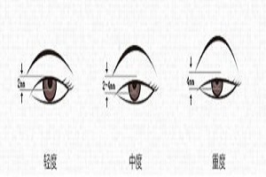 上睑下垂矫正的手术方法