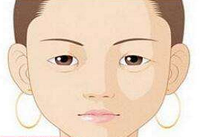 双眼皮修复能恢复成单眼皮吗
