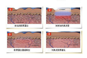 去除黑眼圈大概需要多少钱呢