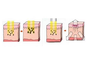 去除黑眼圈的有效方法是什么