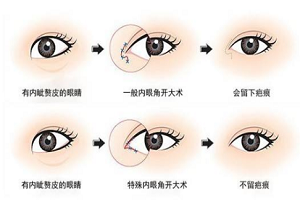 开眼角手术后会有疤痕吗